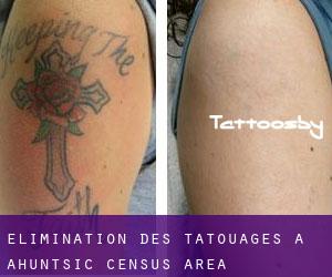 Élimination des tatouages à Ahuntsic (census area)