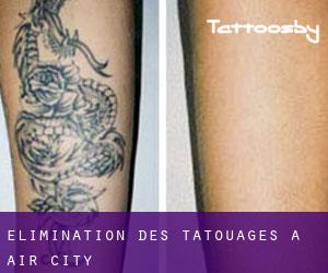 Élimination des tatouages à Air City