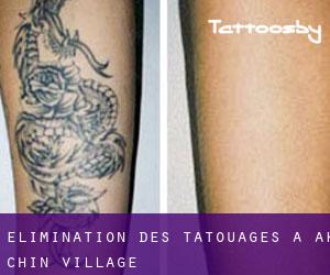 Élimination des tatouages à Ak-Chin Village