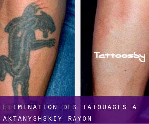 Élimination des tatouages à Aktanyshskiy Rayon