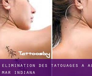Élimination des tatouages à Al-Mar (Indiana)