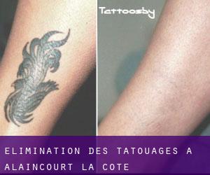 Élimination des tatouages à Alaincourt-la-Côte