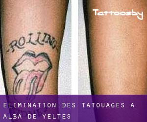 Élimination des tatouages à Alba de Yeltes