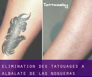 Élimination des tatouages à Albalate de las Nogueras