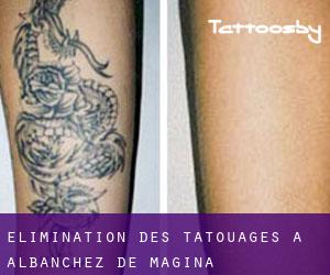 Élimination des tatouages à Albanchez de Mágina