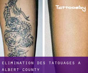 Élimination des tatouages à Albert County