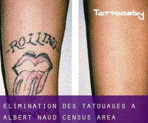 Élimination des tatouages à Albert-Naud (census area)