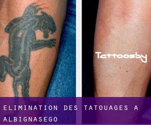 Élimination des tatouages à Albignasego