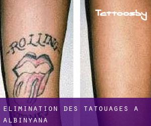 Élimination des tatouages à Albinyana