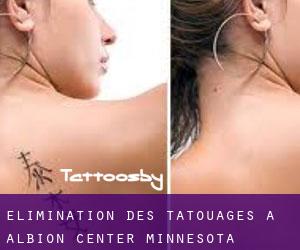 Élimination des tatouages à Albion Center (Minnesota)