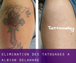 Élimination des tatouages à Albion (Delaware)