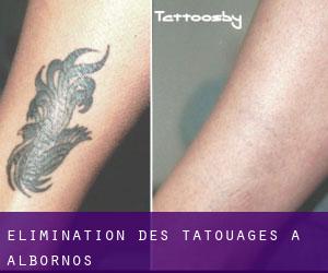 Élimination des tatouages à Albornos