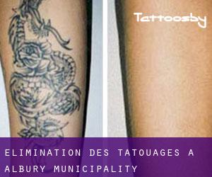 Élimination des tatouages à Albury Municipality