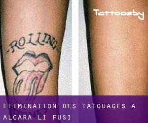 Élimination des tatouages à Alcara Li Fusi