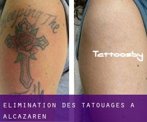 Élimination des tatouages à Alcazarén