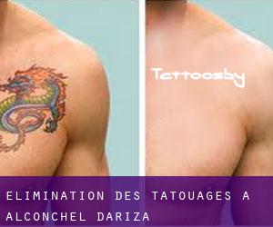 Élimination des tatouages à Alconchel d'Ariza