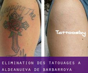 Élimination des tatouages à Aldeanueva de Barbarroya