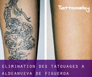 Élimination des tatouages à Aldeanueva de Figueroa