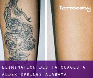 Élimination des tatouages à Alder Springs (Alabama)