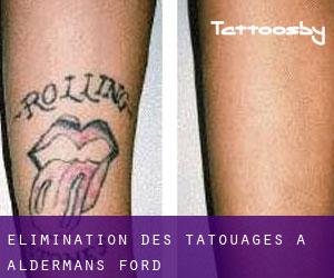 Élimination des tatouages à Aldermans Ford