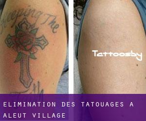 Élimination des tatouages à Aleut Village