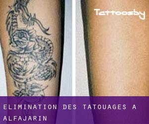 Élimination des tatouages à Alfajarín