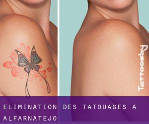Élimination des tatouages à Alfarnatejo