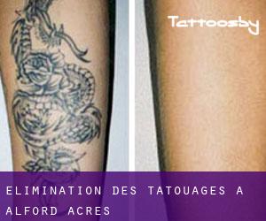 Élimination des tatouages à Alford Acres