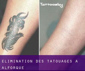 Élimination des tatouages à Alforque