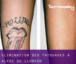 Élimination des tatouages à Alfoz de Lloredo