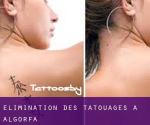Élimination des tatouages à Algorfa