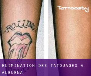 Élimination des tatouages à Algueña