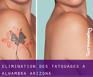 Élimination des tatouages à Alhambra (Arizona)