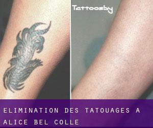 Élimination des tatouages à Alice Bel Colle