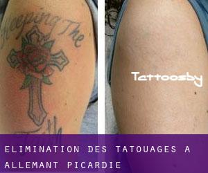 Élimination des tatouages à Allemant (Picardie)