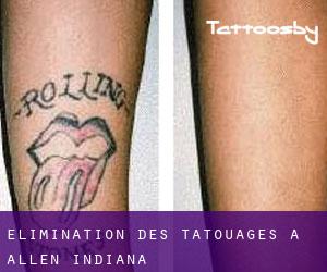 Élimination des tatouages à Allen (Indiana)