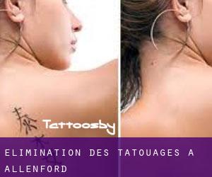 Élimination des tatouages à Allenford