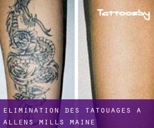 Élimination des tatouages à Allens Mills (Maine)