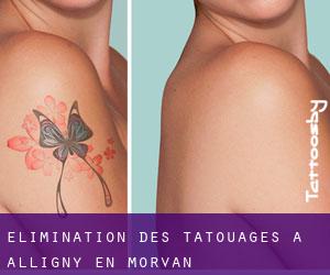 Élimination des tatouages à Alligny-en-Morvan