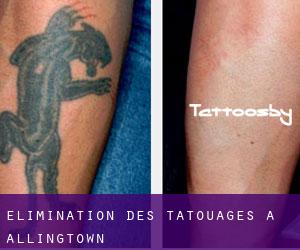 Élimination des tatouages à Allingtown