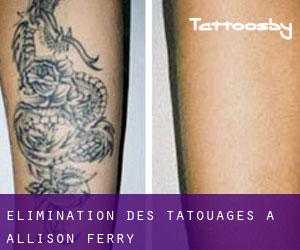 Élimination des tatouages à Allison Ferry
