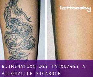 Élimination des tatouages à Allonville (Picardie)