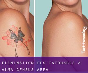 Élimination des tatouages à Alma (census area)