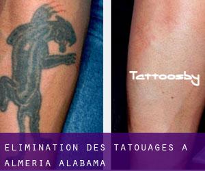 Élimination des tatouages à Almeria (Alabama)