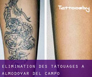 Élimination des tatouages à Almodóvar del Campo