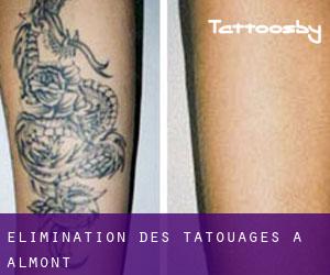 Élimination des tatouages à Almont