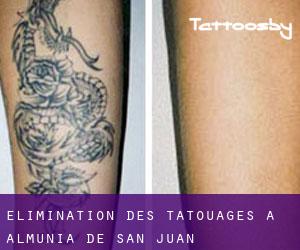 Élimination des tatouages à Almunia de San Juan