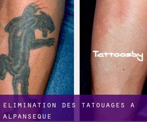 Élimination des tatouages à Alpanseque
