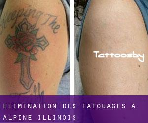 Élimination des tatouages à Alpine (Illinois)