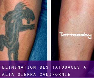 Élimination des tatouages à Alta Sierra (Californie)